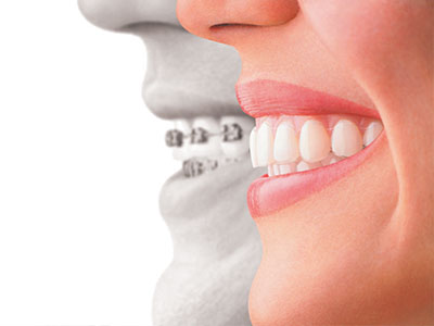 Invisalign Dentist in Hawthorne CA
