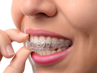 Invisalign Dental Office in Hawthorne CA