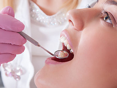 Dental Fillings Hawthorne CA
